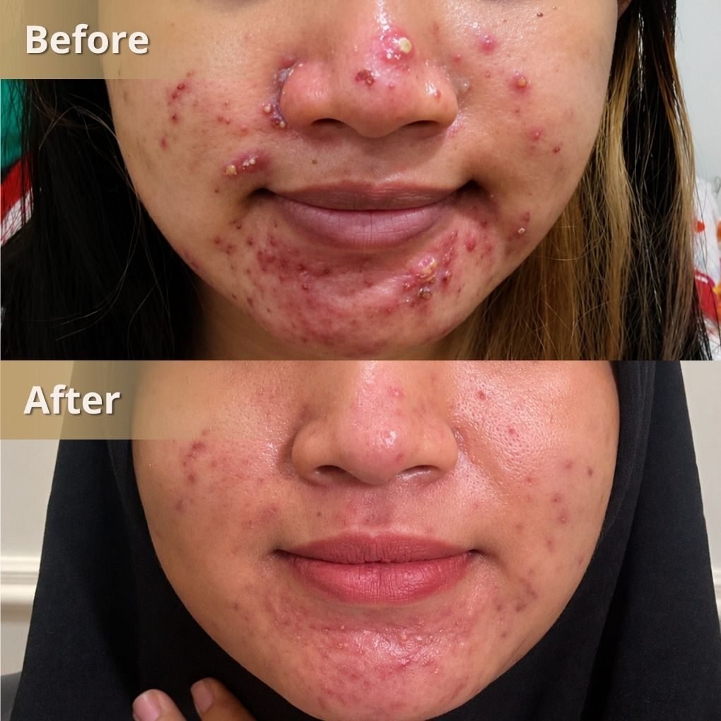 Foto sebelum dan sesudah Acne Skin Booster pada pasien The Mercy Clinic