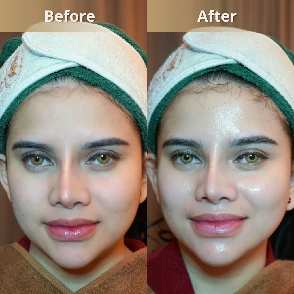 Foto sebelum dan sesudah Snow White Facial + OXY Double Serum pada pasien The Mercy Clinic