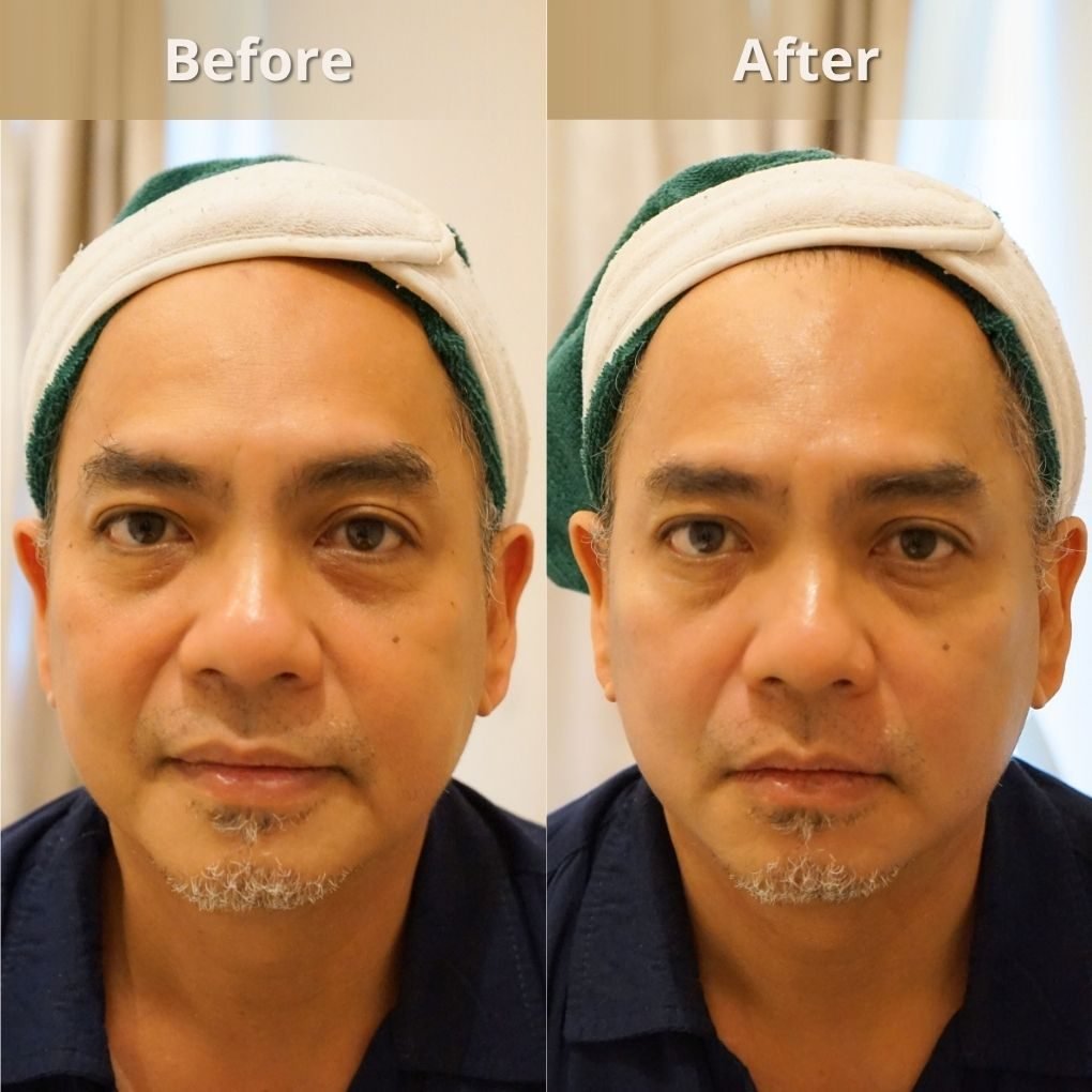 Foto sebelum dan sesudah Ultralift pada pasien The Mercy Clinic